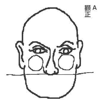 颧骨整形的价位 顴骨的擺位