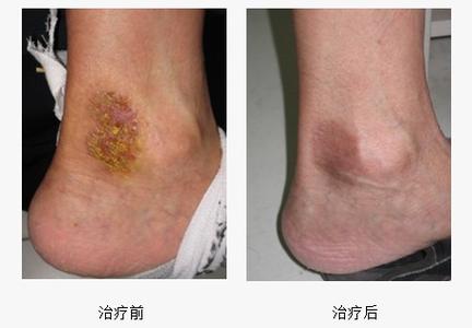 湿疹痊愈过程图 湿疹痊愈过程图 湿疹难痊愈？问问自己，用对药了吗？