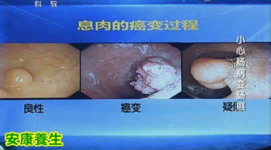 健康之路胆囊息肉 健康之路20150122视频和笔记:纪小龙,大肠息肉,胆囊息肉,腺瘤