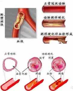 清理血管垃圾的特效药 清理血管垃圾的特效药 清理「血管垃圾」能降压降脂吗？