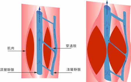 静脉曲张中医疗法 腳踭裂/靜脈曲張療法
