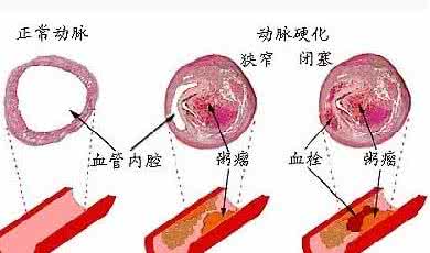 脑血栓形成的原因 脑血栓形成原因 脑血栓形成原因 动脉粥样硬化是基本