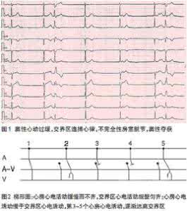 窦性心律过缓的原因 窦性心律过缓 窦性心律过缓的概述