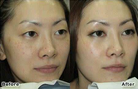 晒斑激光多少钱 激光去晒斑 激光去日晒斑 放心“一夏”