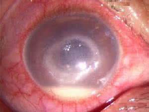 全葡萄膜炎 虹膜睫状体炎（前葡萄膜炎）