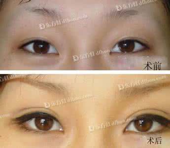 双眼皮失败能修改吗 双眼皮失败能修改吗 双眼皮失败的判定及修改