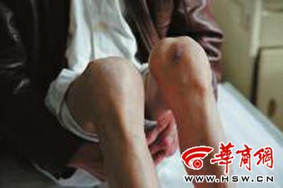 风湿性关节炎类风湿 类风湿关节炎 风湿性关节炎怎么治 得了风湿性关节炎可以试试这些方法