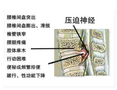 腰椎间盘突出中药方剂 腰椎间盘突出需科学治疗 推荐7款中医方剂