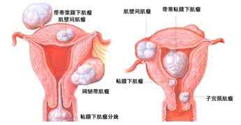 子宫腺肌瘤能治好吗 宫腔肌瘤好吗？