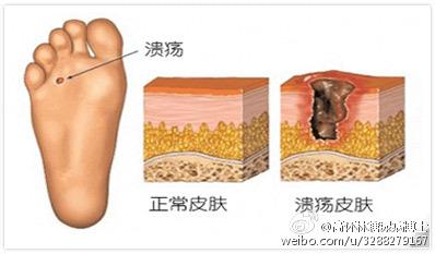 糖尿病足有什么症状 糖尿病足有什么症状 糖尿病足的常见症状有什么