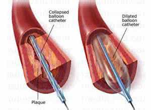 怎样防止血管硬化 它是防心脏病、血管硬化的水果王:现在就是当季!别错过~