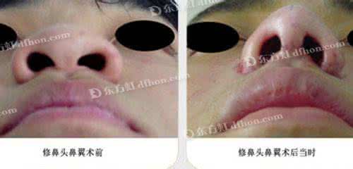 鼻头改小整容 鼻头改小整容 应该怎样使大鼻头改小呢