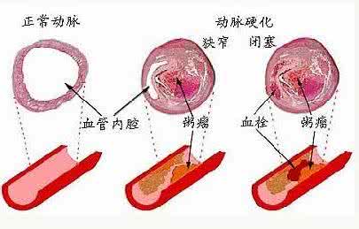 动脉硬化的原因 动脉硬化的原因 这些因素会造成动脉硬化