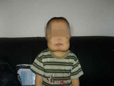 地中海贫血症是什么 地中海贫血症 什么是地中海贫血症