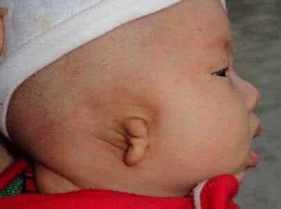 宝宝耳朵畸形怎么办 宝宝耳朵畸形怎么办 哪些情况下易生畸形宝宝?