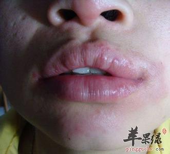 芒果过敏怎么治好的快 芒果过敏怎么办