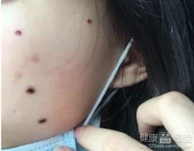 激光点痣后怎么护理 激光点痣后怎么护理 激光点痣之后的护理方法