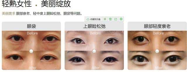 女性美容 眼部美容医院 眼部美容，是女性美容的重要内容