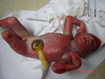 造成胎儿畸形的原因 畸形胎儿是如何造成的 这些地方是引起胎儿畸形的重灾区，应一定避开！