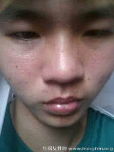 脸颊两侧长斑的原因 脸颊两边斑 脸颊两边长斑的原因及治疗方法