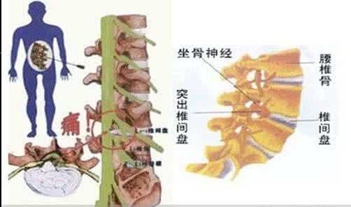 腰间盘突出治疗方法 治疗腰间盘突出方法汇集 51