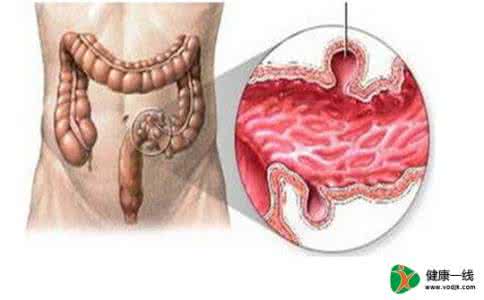 肠炎有什么症状表现 慢性肠炎早期症状
