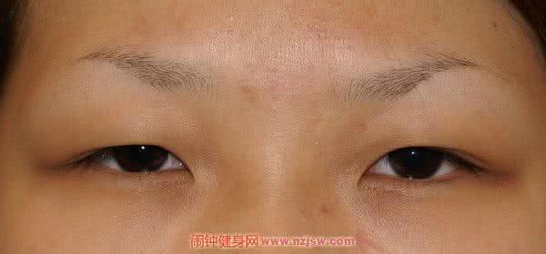 眼睛天生浮肿怎么办 早上眼睛浮肿怎么办?眼睛浮肿的原因