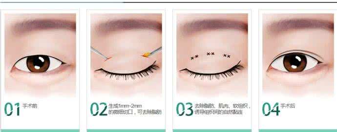 双眼皮手术方法 做双眼皮手术方法 如何选择双眼皮再手术方法