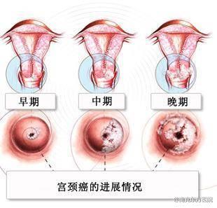 宫颈柱状上皮异位 宫颈癌的早期症状 宫颈柱状上皮异位治疗