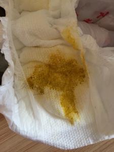 两个月宝宝拉稀图片 两个月宝宝拉肚子怎么办