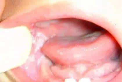 鹅口疮病因 宝宝有鹅口疮怎么办 鹅口疮的病因有哪些