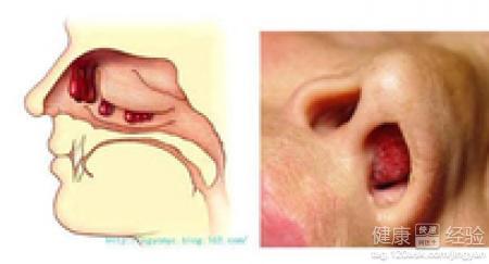 鼻炎鼻息肉手术 鼻炎 鼻息肉