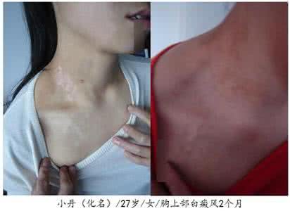 治疗白斑病哪个效果好 白斑病如何治疗效果好 为什么你的白斑没好转?这些因素影响治疗效果!