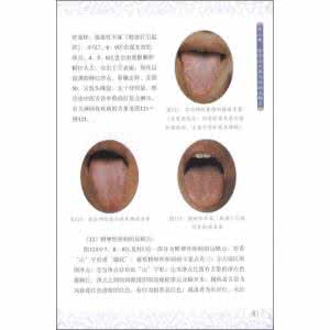 慢性胃炎分型 老中医分型治疗糜烂性胃炎