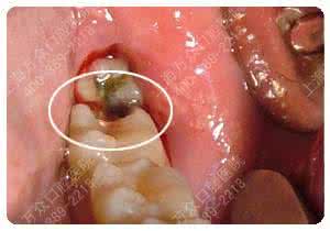 智齿冠周炎的治疗方法 智齿冠周炎 引发智齿冠周炎的原因