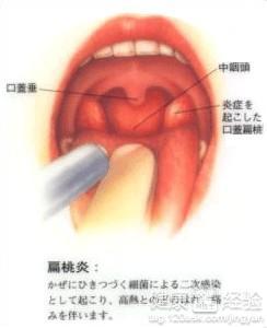 扁桃体炎会引起发烧吗 扁桃体炎发烧 扁桃体炎引起发烧的处理方法