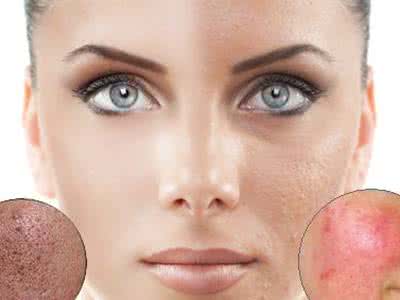 痘印能完全消除吗 痘印能消除吗 痘印能完全消除吗？