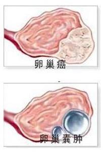 卵巢囊肿破裂的症状 卵巢囊肿破裂的症状 卵巢囊肿症状早知道