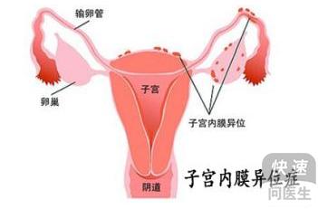 子宫内膜异位症 怀孕 内膜异位症怀孕解决