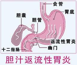 胆汁反流性胃炎 四大人群易患胆汁反流性胃炎 治疗要趁早