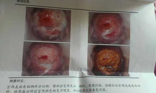 宫颈糜烂修复后流黄水 宫颈糜烂需要手术吗 宫颈糜烂手术后流黄水的介绍