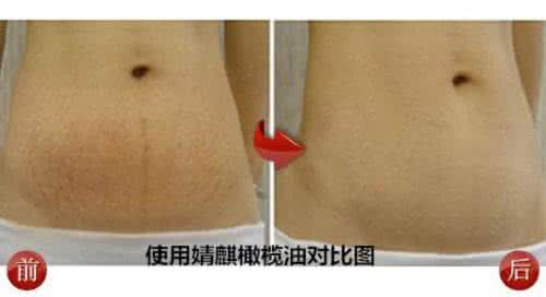 橄榄油去除妊娠纹 橄榄油去除妊娠纹 妊娠纹怎么消除:教你橄榄油去妊娠纹的方法