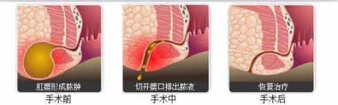 2016治肛瘘偏方绝招 肛瘘3方