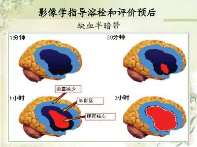 银杏叶滴丸效果怎么样 银杏叶滴丸治疗急性脑梗死的效果如何?