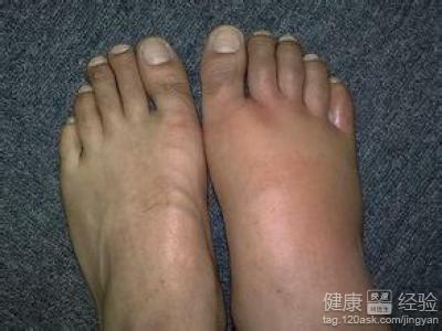 下肢丹毒最好治疗方法 丹毒最好治疗方法