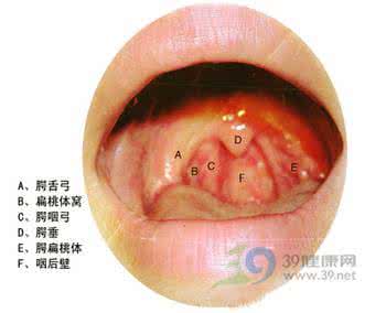 梅核气就是慢性咽炎吗 梅核气 慢性咽炎一次即愈绝技！