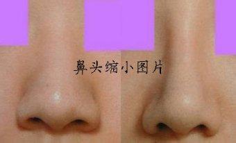 使鼻头变小的小窍门图 怎样使鼻头变小 怎样让鼻头变小