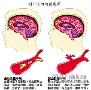 脑血管病 脑血管病（脑血栓形成、闭塞性脑血管炎、脑溢血后期）