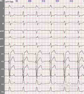 完全性左束支传导阻滞 完全性左束支传导阻滞 双束支阻滞、房室交接性逸搏心律合并左束支内文氏现象心电图精解