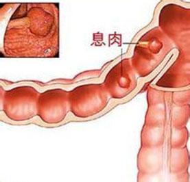 肛门息肉有什么危害 肛门息肉有什么危害 4种水果让你远离痛苦